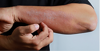 50694 Gut microbiome differences between patients with moderate to severe Chronic Hand Eczema and healthy subjects