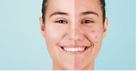 Lysine-Dendrimer, a New Non-Aggressive Solution to Rebalance the Microbiota of Acne-Prone Skin
